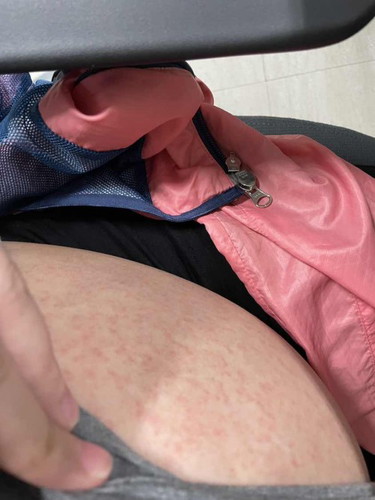 Ano po kayang rashes ito?
