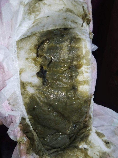 3mos and 21days old si Baby and nestogen 1 formula ni baby