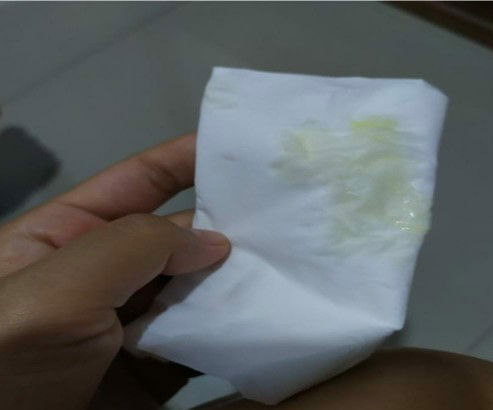 Ketuban atau keputihan uk 32 week