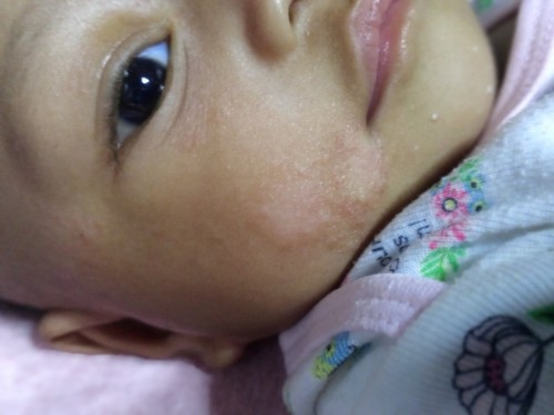 Rashes ni baby