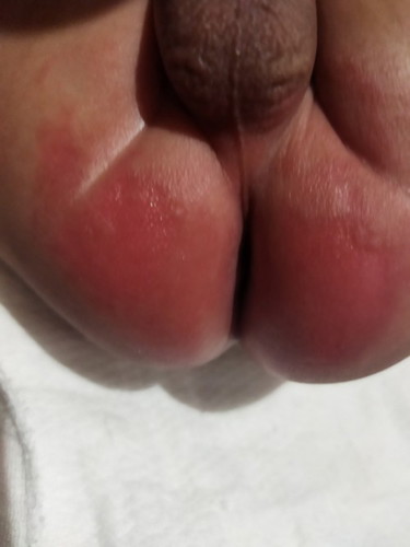 Good afternoon mga mii .
Sa tingin nyo po halas to . Nilagyan ko po ng cream ng calmoseptine