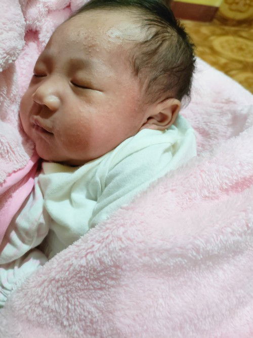 New born skin allergy