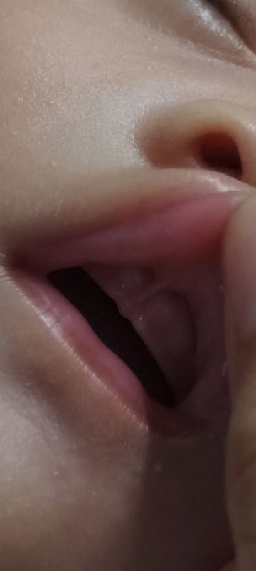 Assalamualaikum anakku Jika seperti ini disebut liptie mom? baiknya diapakan ya mom?