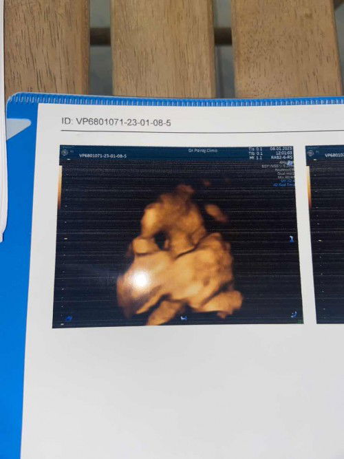 ตั้งครรภ์39+1weeks.อยากคลอดแล้ว