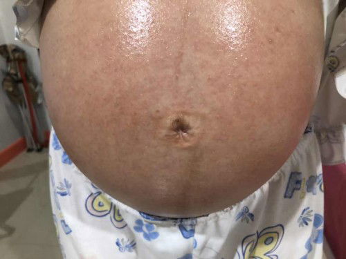 ตั้งครรภ์ได้ 6 เดือน แบบนี้ท้องจะเป็นรอยแตกไหม ??