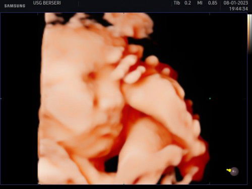 Hasil USG anakku usia 31 Weeks
