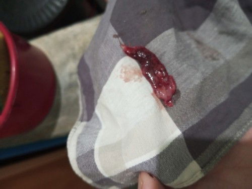 Ano po kaya to? Miscarriage? Di naman po siguro ako nabuntis.