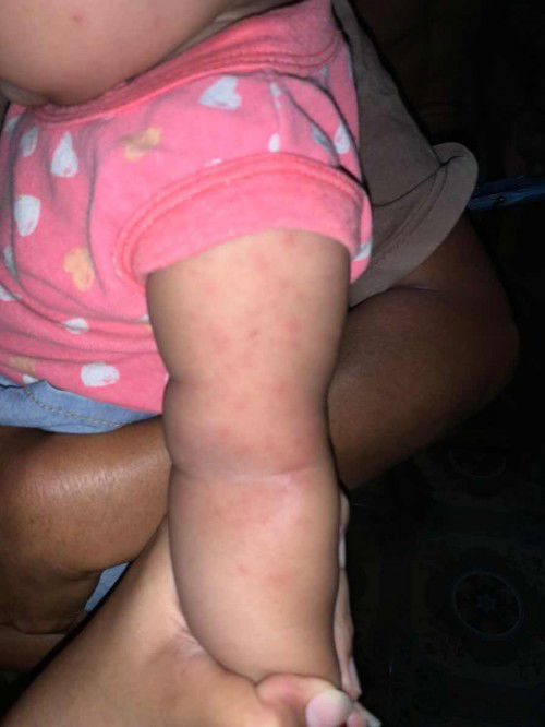 Beruntusan (keringat buntet)