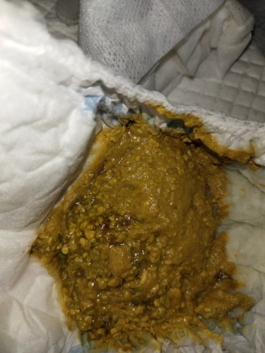 อุจจาระปกติมั้ย