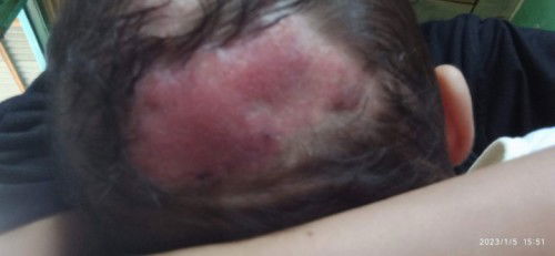 Bintik pada kepala bayi