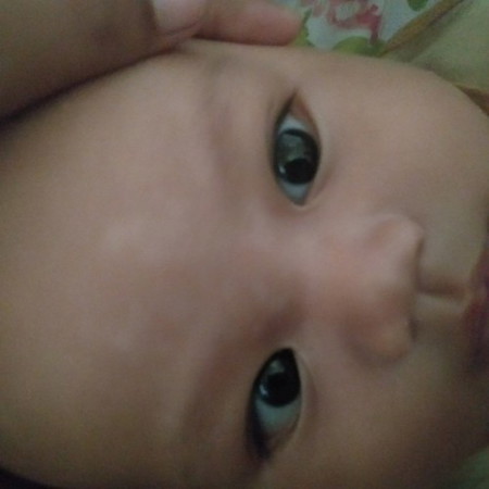 Bun,di jidat anak ku ada seperti panu itu gimana ya ngilanginnya? sdh ku salep solenfik tp g pudar