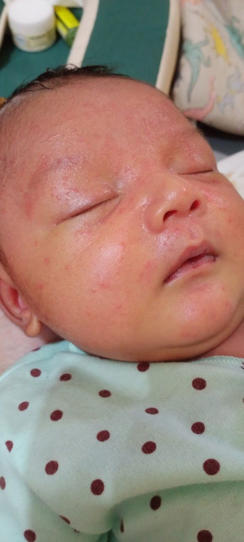 Muncul bintik bintik pada wajah newborn