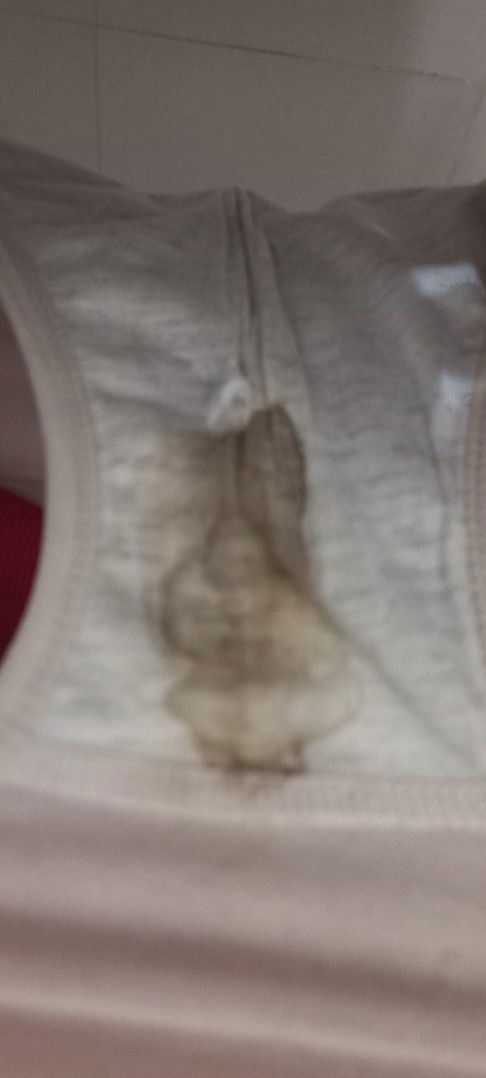 Flek setelah melahirkan