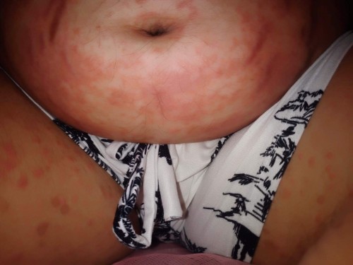 28weeks may rashes