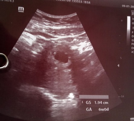 อยากได้เขามากขออย่าให้เป้นท้องลมเลยนะพูดไม่ออกเลยค่ะคุณหมอยังไม่เสียงหัวใจของเด็กยังไม่เห็นอะไรเลย😭