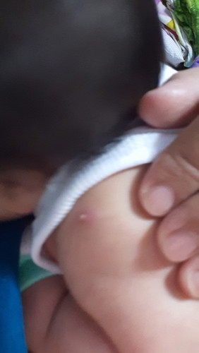 Mga mommy normal lang poba yung parang nana na lumabas sa pinagturukan sa braso ng anak ko nung