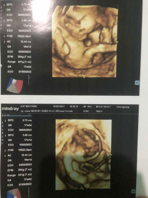 Lihat jenis kelamin dari hasil usg