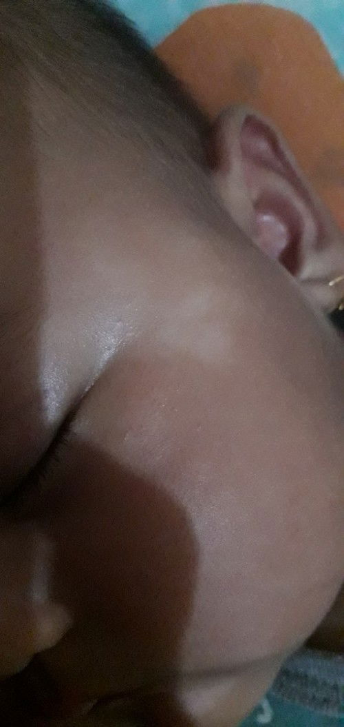 Boleh minta sarannya ga bun, kalau ada bercak putih di pinggir mata itu apa ya & diobatin apa ya ?