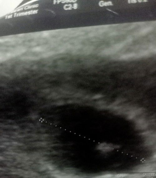 8w แล้วหมอบอกมีโอกาสท้องลมสูงมาก พอมีความหวังอยู่ไหมคะ