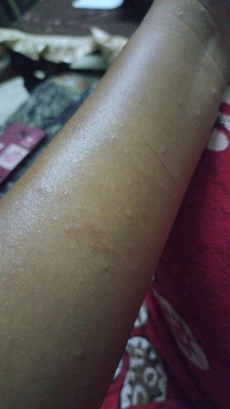 Bintik merah di tngn, lengan, dada, perut