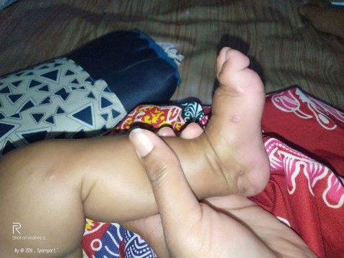 gatal dikaki pada bayi