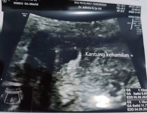 Gambaran USG 6 minggu