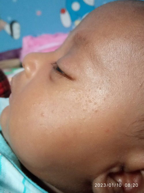 Bintik"pada bayi 1 bln