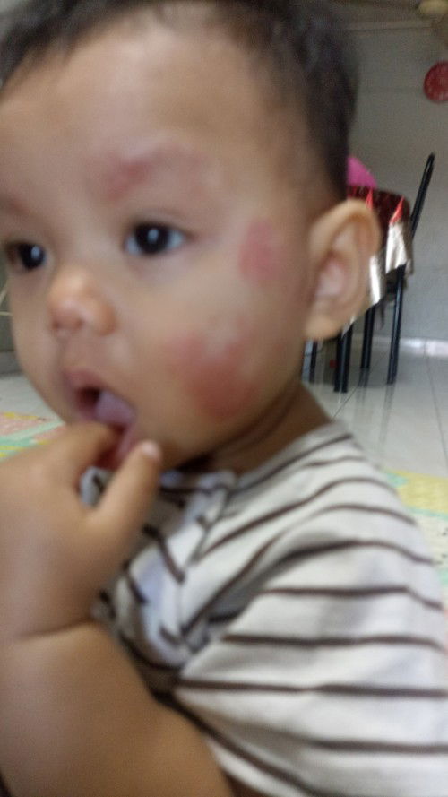 Ruam atau eczema?