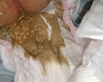 Normal ba ang ganitong poop ni baby ?