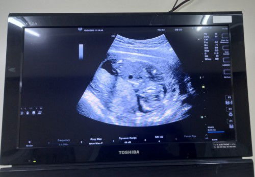 อัลตร้าซาวด์15w