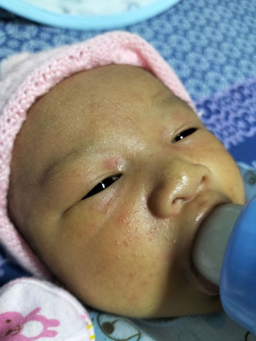 หน้าน้องเป็นผื่น