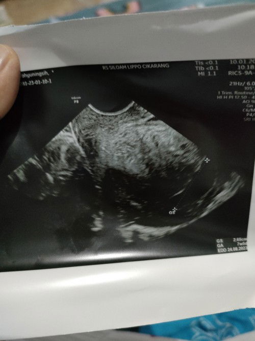 USG 2/1/2023 usia 8 Minggu, USG lg 10/1/2023 karena flek usia 7 minggu