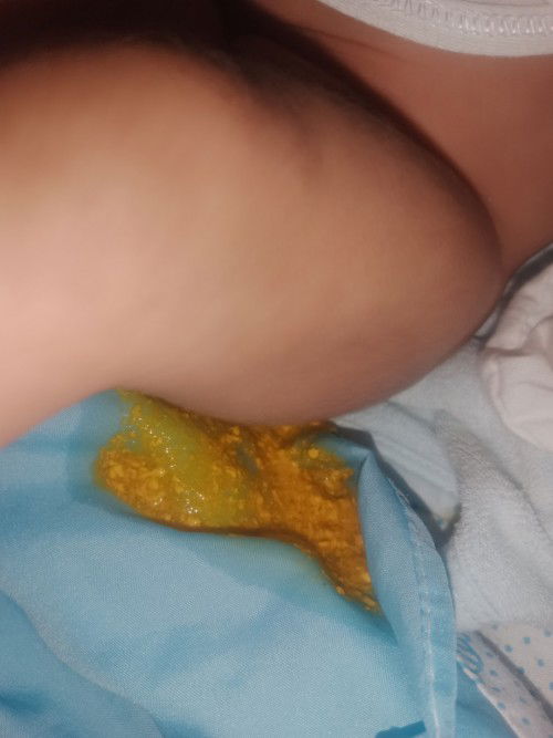 Hi gusto ko lang itanong normal po bang poops ni baby pure breastfeed po mag 1mnth palang dis jan 14