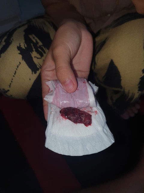 haid pertama hari ke 7 ada darah gumpal setelah kb 3 bulan