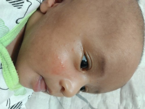 Ruam bayi 23 hari