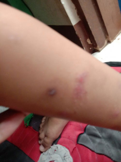 Hi mommies! Tanong ko lang po, ano po magandang sabon, lotion at gamot sa sa kati at sugat ng bby ko