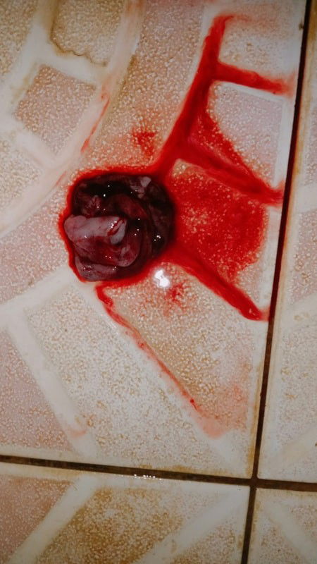 Keguguran di UK 7minggu 2hari