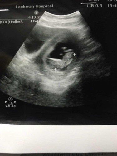 ท้องแรก มาแชร์ประสบการณ์กันค่ะ