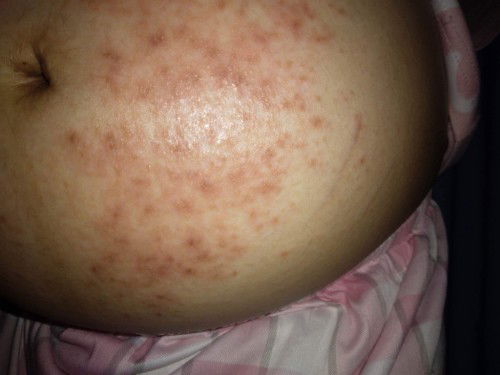 hello mga sis ika 3rd trimester ko at nag karoon ako ng rashes