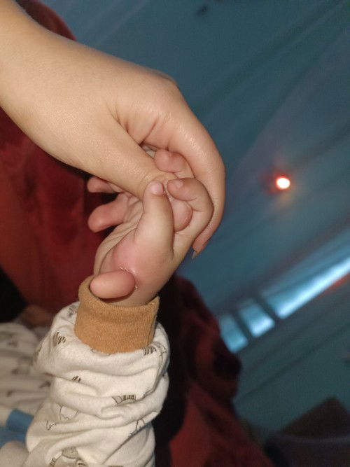 Thắt chỉ thịt thừa