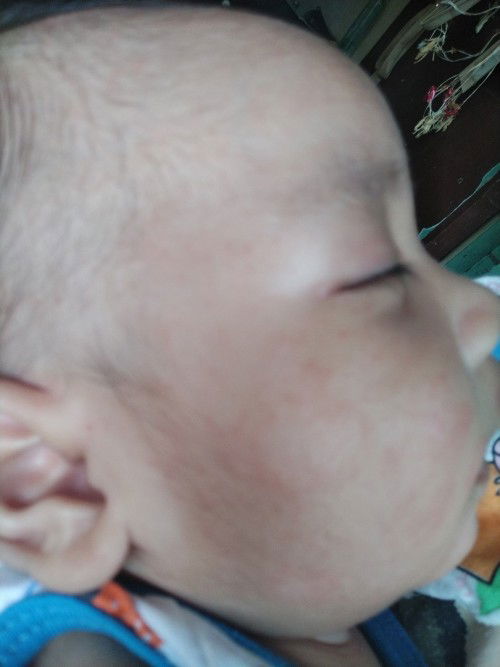 Rashes sa mukha ni baby 3 months old