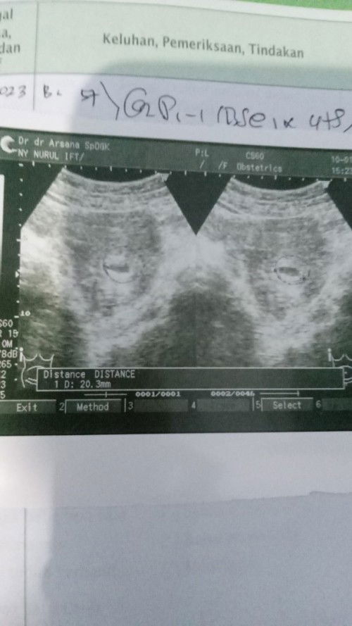 Pendarahan sebentar hamil 6W