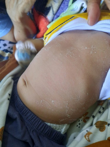 Bunda.. saya mau tanya kenapa kulit anak saya 2 bulan mengelupas seperti ini / ganti kulit ya?