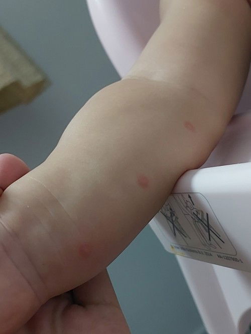 Bintik merah tangan baby