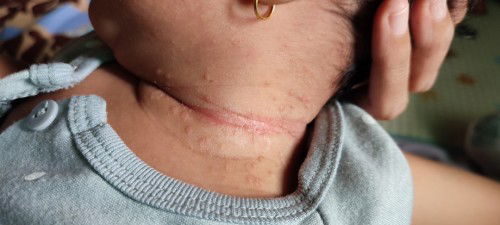 anak saya ada ruam di bagian lipatan lehernya, dan ada bau kurang enak. 
kira2 obatnya apa ya?