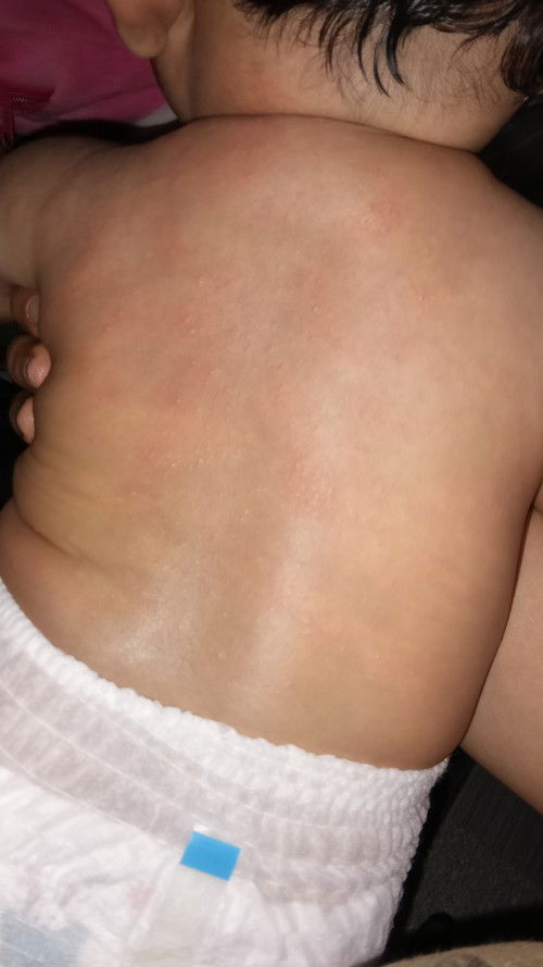 Sye ingin bertnyaa,, kenapa yee badan anak sye jadi gini .. sebab panas ke ? Da 3hari jadi gini 😭