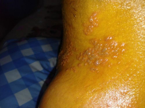 Kena herpes saat mendekati hpl