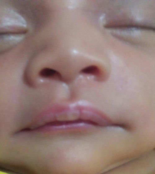 Bibir bayi baru lahir luka