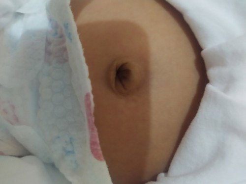 Normal Lang po ba Yung pusod ni baby?