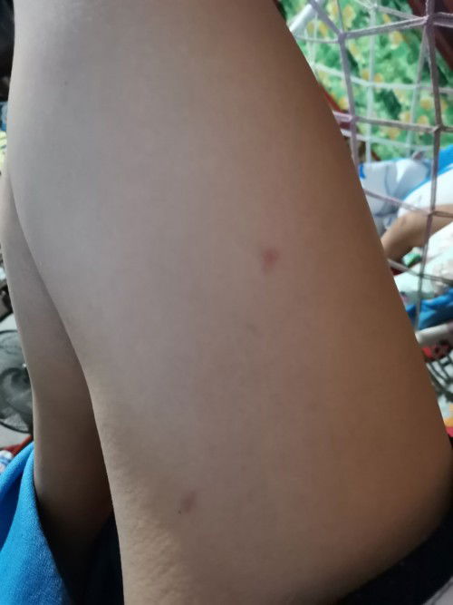 Rashes during pregnancy?